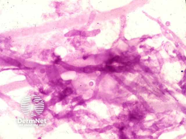ШИК-реакция (PAS-окрашивание): элементы Aspergillus в биоптате кожи