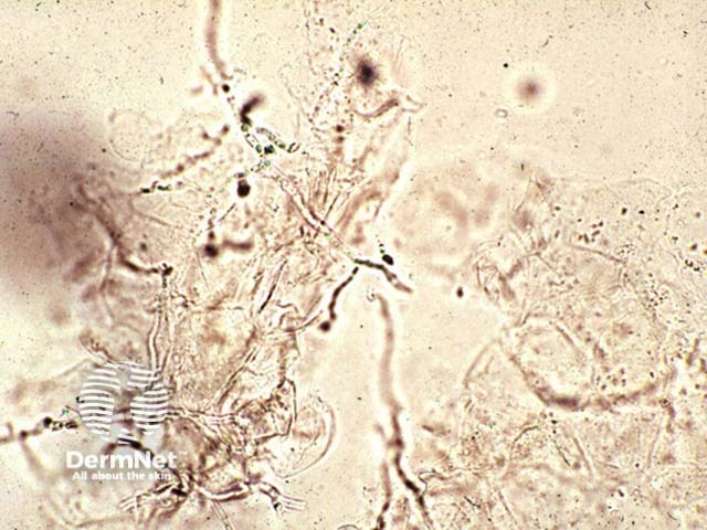 КОН-микроскопия: гифы Microsporum canis
