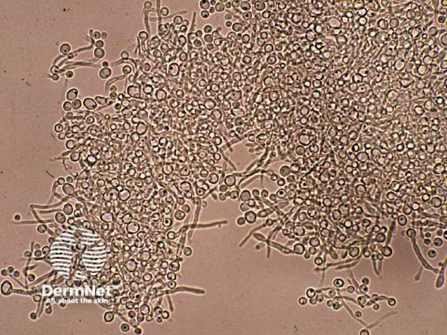 КОН-микроскопия: псевдогифы и бластоспоры Candida
