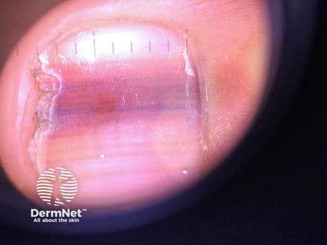 Продольная меланонихия ногтя пальца кисти при синдроме Ложье — Хунцикера