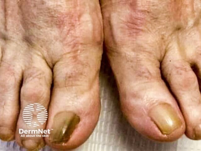 Продольная меланонихия при синдроме Ложье — Хунцикера