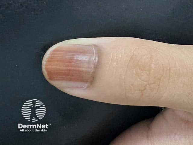 Продольная меланонихия при синдроме Ложье — Хунцикера