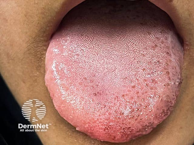 Пигментные пятна на языке при синдроме Ложье — Хунцикера: аналогичная пигментация может наблюдаться на губах и нёбе