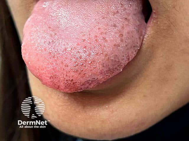 Пигментные пятна на языке при синдроме Ложье — Хунцикера: аналогичная пигментация может наблюдаться на губах и нёбе