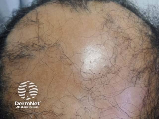 Атрофические изменения кожи волосистой части головы у мужчины с синдромом Грэхема — Литтла