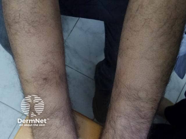 Клинические проявления синдрома Грэхема — Литтла: алопеция в области кожи предплечья
