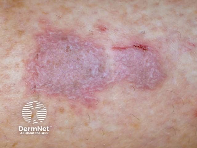 Бляшка красного плоского лишая крупным планом: отчетливо видна сетка Уикхема
