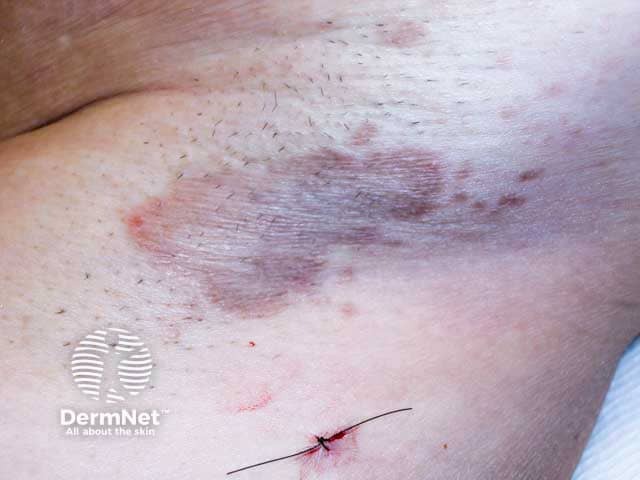 Аксиллярный красный плоский лишай: кольцевидные элементы с поствоспалительной пигментацией
