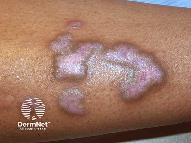 Возвышающиеся экскориированные фиолетовые бляшки на голени при гипертрофическом красном плоском лишае