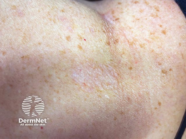 Бледная шелушащаяся бляшка на коже туловища при экстрагенитальном склероатрофическом лихене