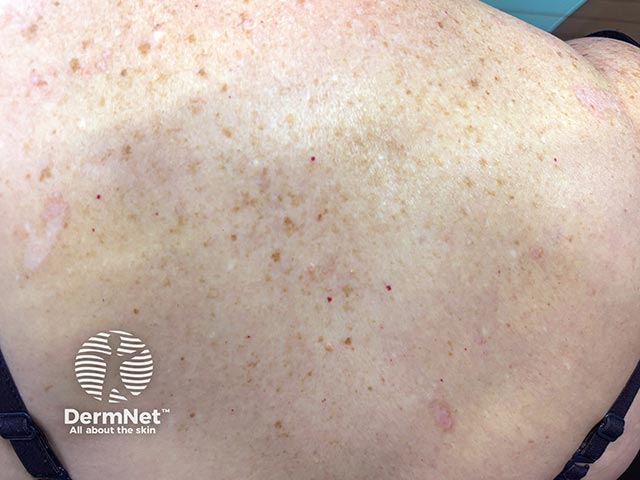 Бляшки склероатрофического лихена на коже спины