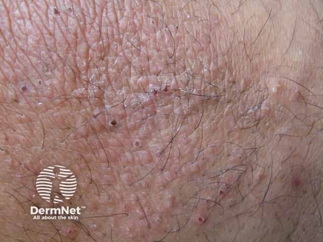 Усиление кожного рисунка и лихенификация при простом лишае на боковой поверхности шеи