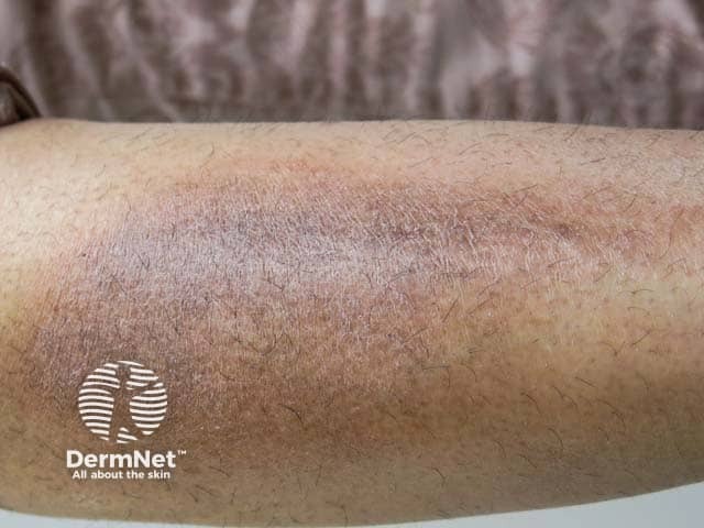 Гиперпигментация и лихенификация при простом лишае на коже руки