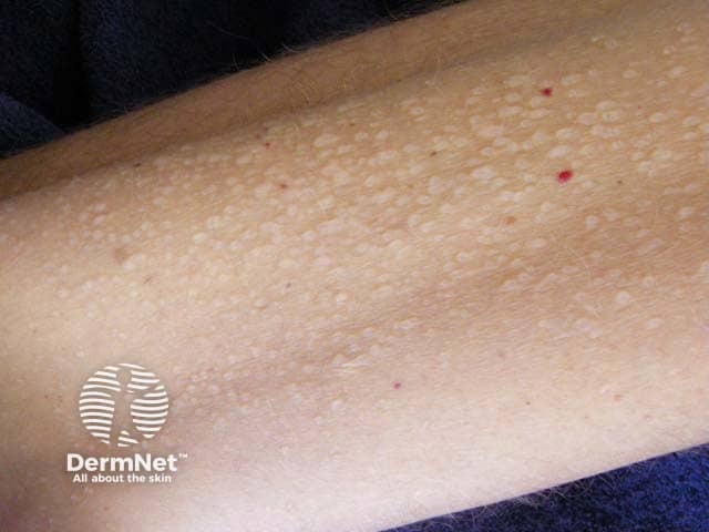 Индуцированный ванкомицином везикулезный линейный IgA-зависимый дерматоз