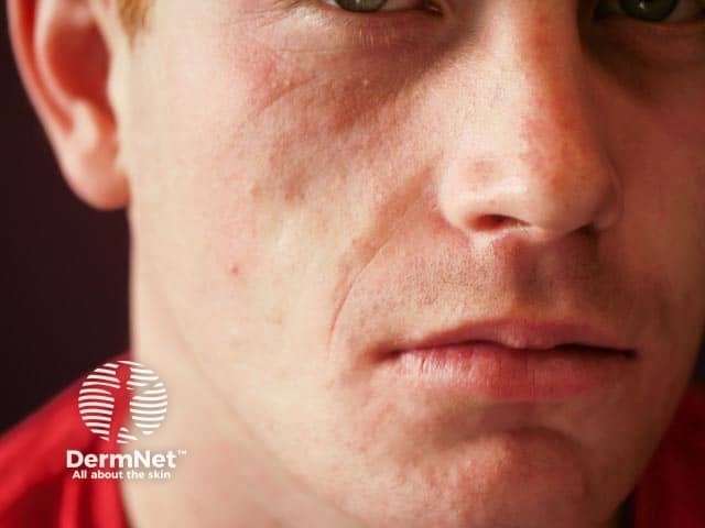 Идиопатическая локализованная липоатрофия лица