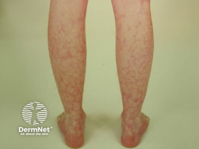 Сетчатое ливедо (livedo reticularis)