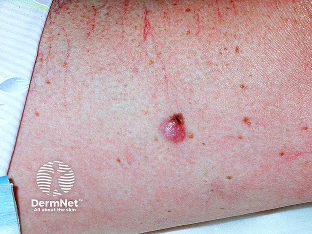 Опухоль из клеток Меркеля на бедре