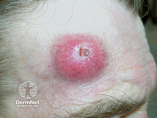 Крупная опухоль из клеток Меркеля с изъязвлением в центре у пациента с ХЛЛ