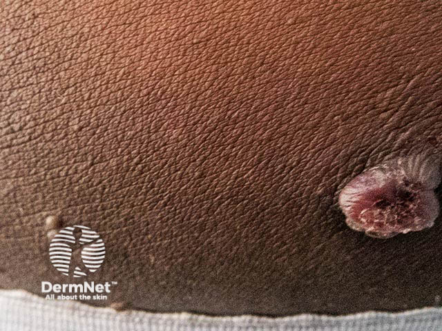 Высыпания контагиозного моллюска на коже IV–VI фототипов