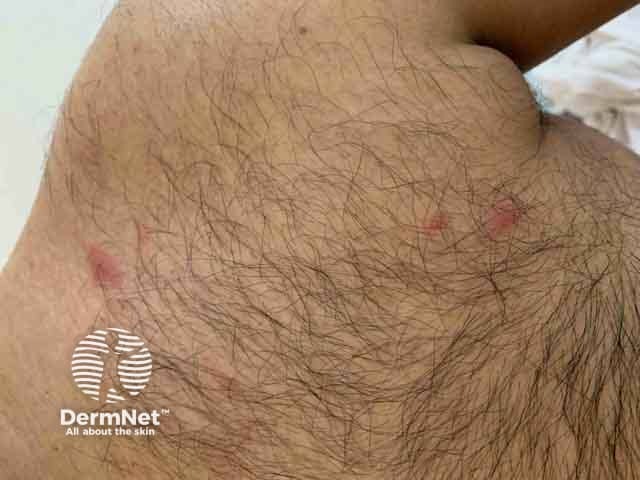 Ранние папулезные элементы при оспе обезьян на туловище