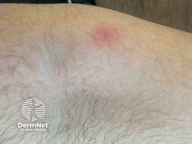 Ранний везикулезный элемент при оспе обезьян в области локтевой ямки