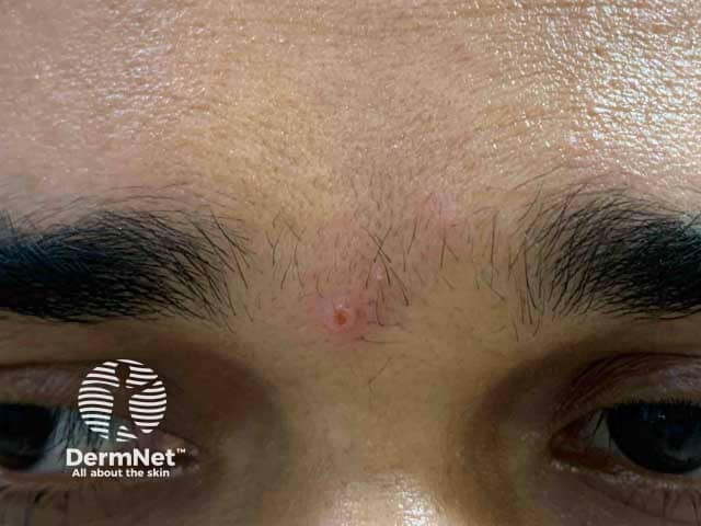 Ранний элемент при оспе обезьян в области глабеллы