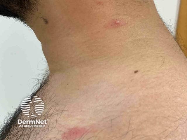 Ранние высыпания при оспе обезьян на груди и шее