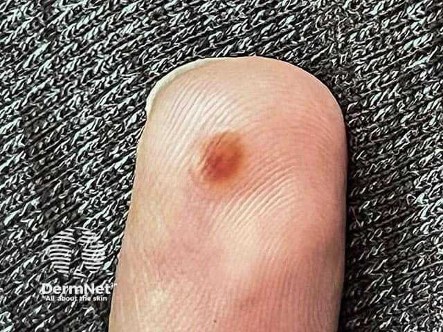 Разрешающийся элемент оспы обезьян с постпустулезной пигментацией