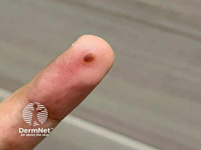 Разрешающийся элемент оспы обезьян с постпустулезной пигментацией
