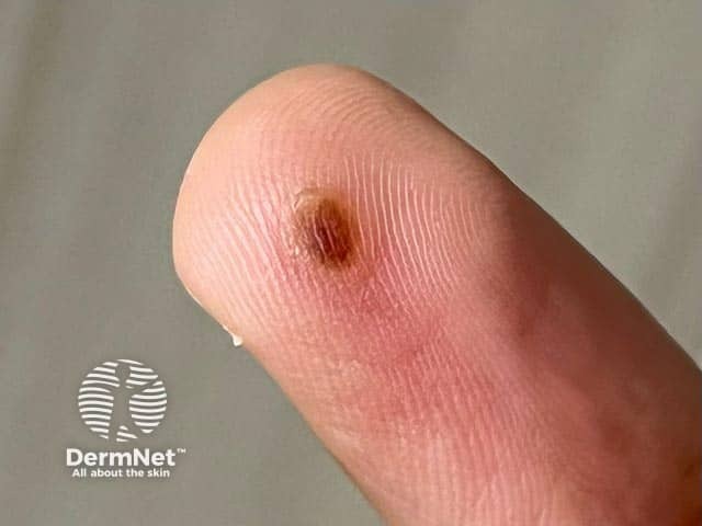 Разрешающийся элемент оспы обезьян с постпустулезной пигментацией