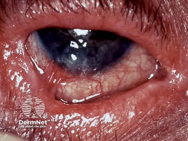 Рубцевание и воспаление конъюнктивы при пемфигоиде слизистых оболочек