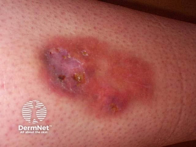 Осложнение липоидного некробиоза: глубокое болезненное изъязвление на голени