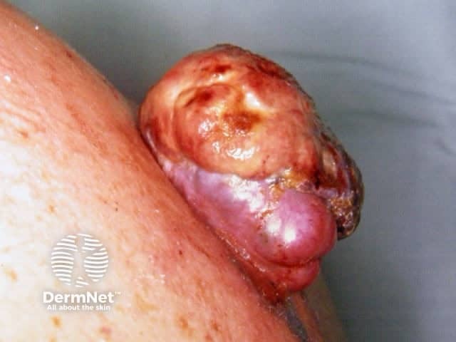 Изъязвленная узловая меланома