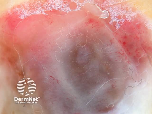 Дерматоскопия узловой меланомы пяточной области