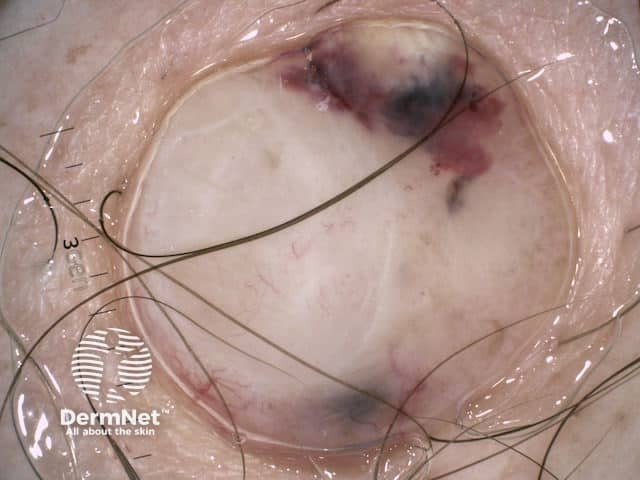 Узловая меланома, толщина по Бреслоу 7,2 мм, динамика изменений за 12 недель до иссечения, неполяризационная дерматоскопия