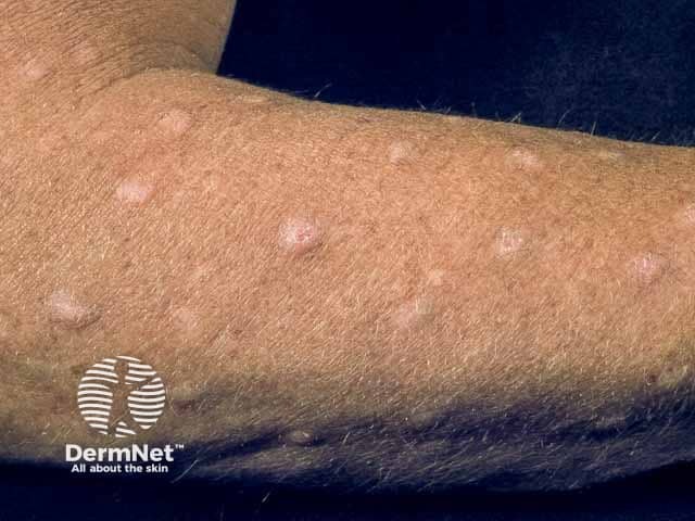 Очаги узловатой почесухи на коже верхних конечностей