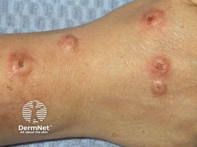 Куполообразные узлы пруриго в перималлеолярной зоне