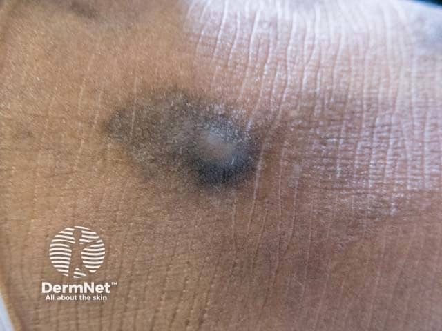 Гиперпигментированные узлы пруриго на темной коже