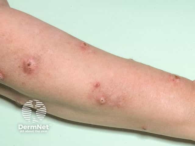 Крупные узловые элементы почесухи на руке