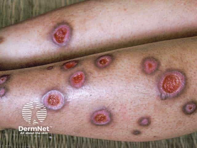 Изъязвленный узел пруриго вследствие постоянных расчесов