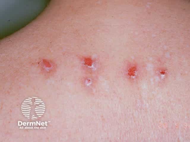 Экскориированные элементы пруриго с явлениями мокнутия на коже шеи