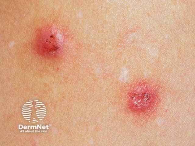 Экскориированные узловые элементы при пруриго Гайды