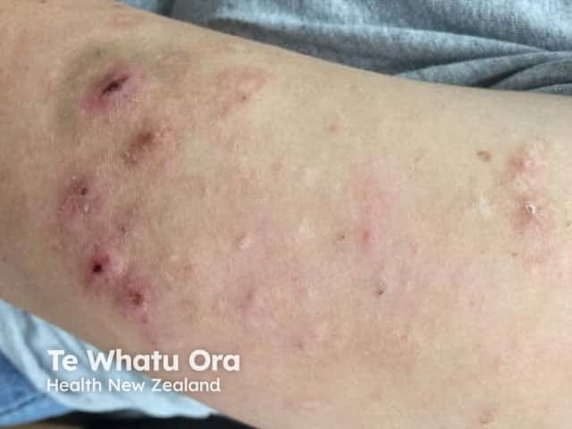 Локализация узловатой почесухи на руке у 24-летней пациентки