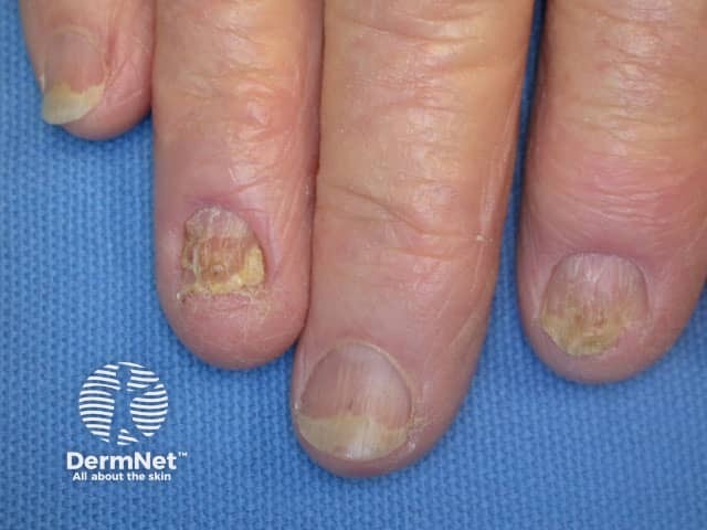 Красный плоский лишай ногтей: онихолизис на 3-м и 5-м пальцах кисти