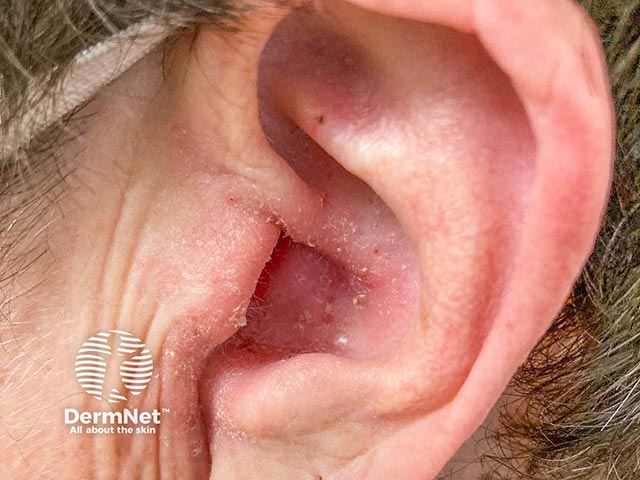 Эритема и шелушение в чаше ушной раковины и наружном слуховом проходе на фоне наружного отита