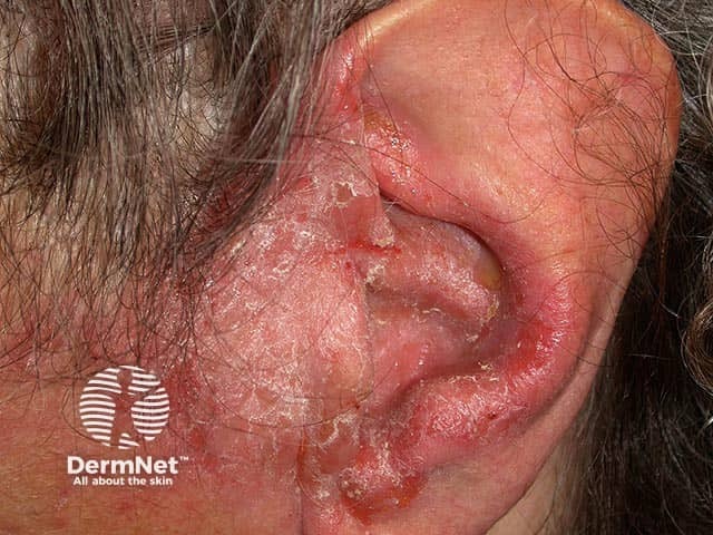Хронический наружный отит с переходом воспаления на предушную область