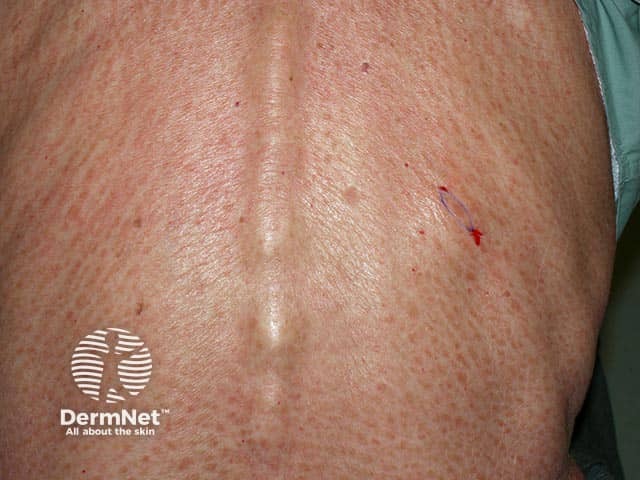 Полосовидные высыпания красных папул на спине при папулоэритродермии