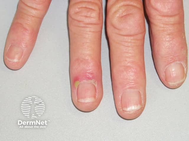 Паронихия