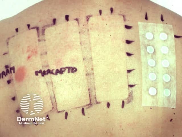 Снятие патч-теста через 48 часов с положительной реакцией на ускоритель вулканизации каучука