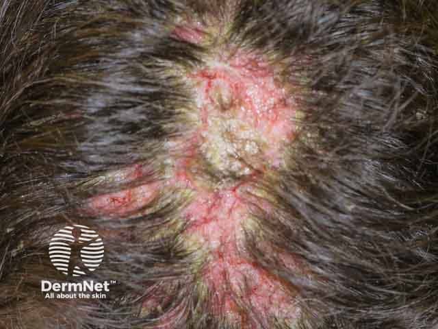 Мацерация и корки на коже волосистой части головы при вульгарной пузырчатке